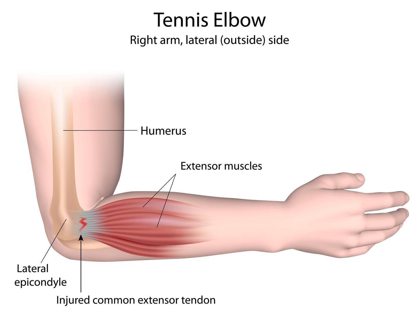 Cure for tennis elbow (lateral. 